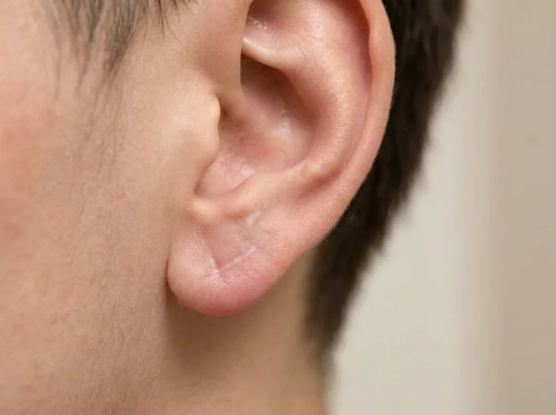 After Earlobe Surgery — Restored Smooth Contour and Healed Lobule