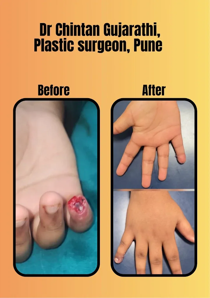 Hand and Finger Tip Reconstruction Before and After by Dr. Chintan Gujarathi Pune
