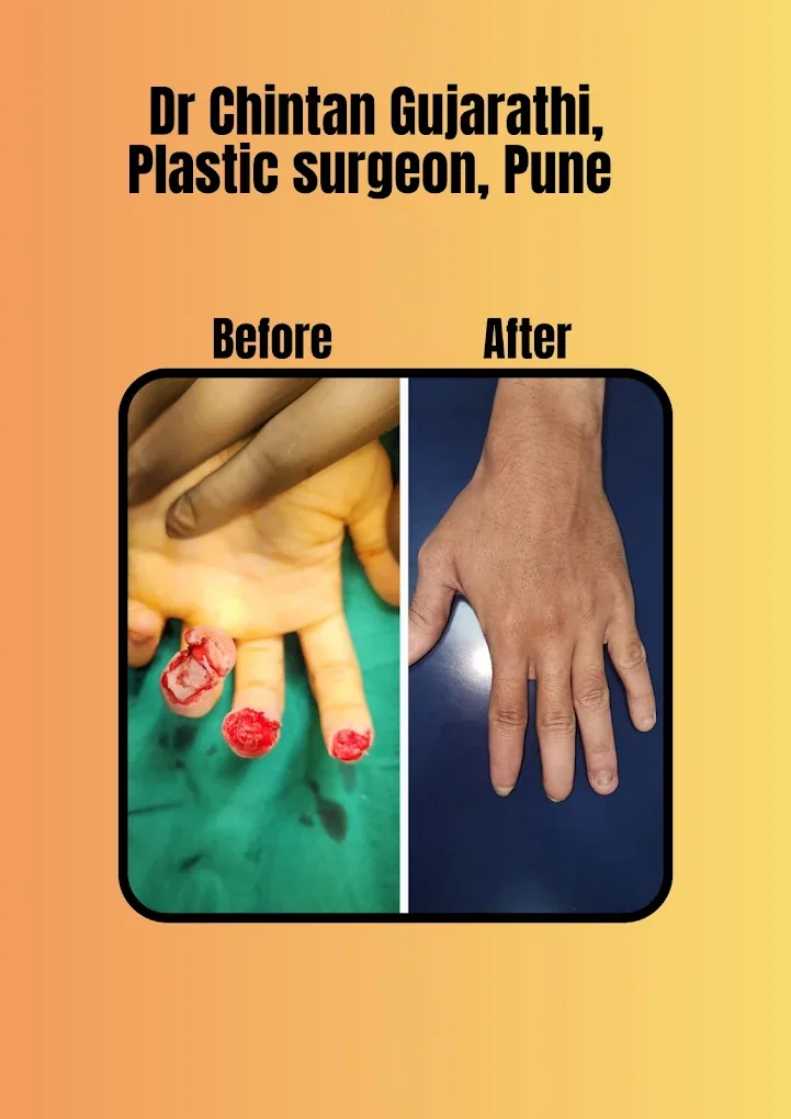 Complex Multi-Digit Hand Reconstruction Before and After by Dr. Chintan Gujarathi Pune