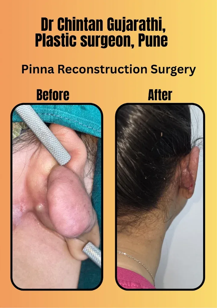 Pinna Reconstruction Surgery Before and After by Dr. Chintan Gujarathi Pune